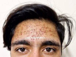 آکنه و کومدون درپیشانی و صورت پسر نوجوان