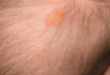 uvenile_xanthogranuloma scalp of a baby