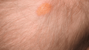uvenile_xanthogranuloma scalp of a baby